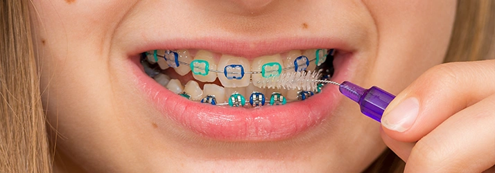 Helpful Tips To Stay On Track With Your Braces In The Woodlands TX Helpful Tips To Stay On Track With Your Braces In The Woodlands TX