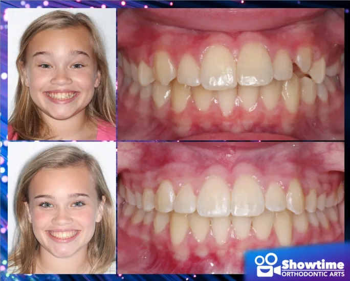 Before And After Of A Patients Teeth