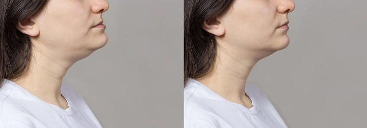 Orthognathic Surgery in The Woodlands TX Orthognathic Surgery in The Woodlands TX