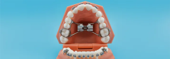 Orthodontist The Woodlands TX Expander Palatal Expander in a model of a mouth.