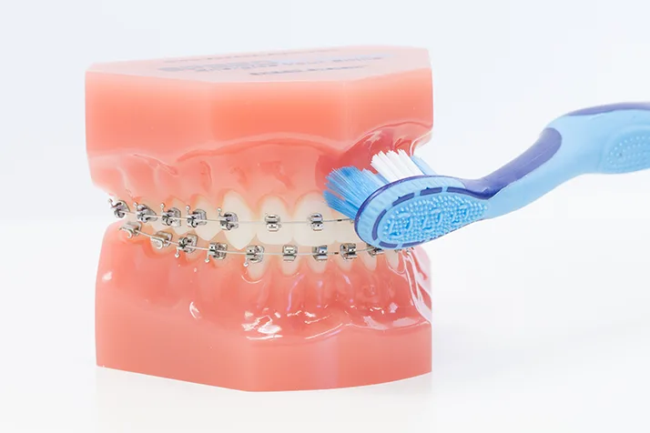 A model of a mouth being brushed with a blue tooth brush. The mouth is closed and has braces.