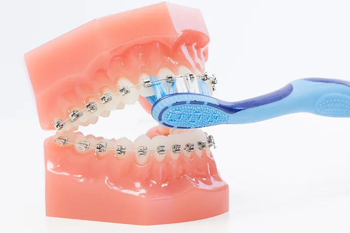 A model of a mouth being brushed with a blue tooth brush. The mouth is open with braces.