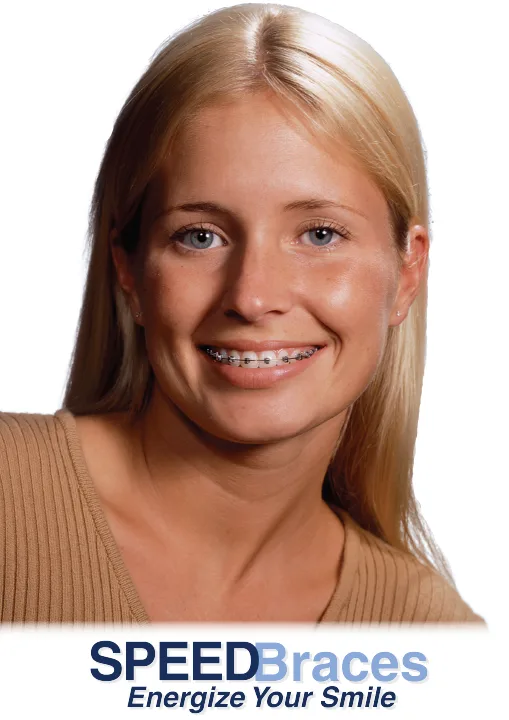 A blonde girl smiling with speed braces on.
