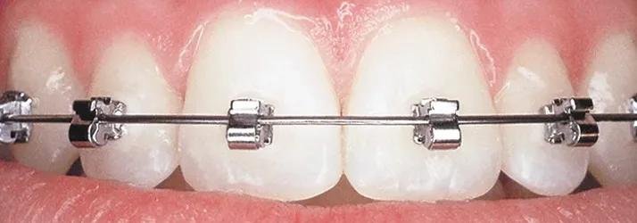 Close up of speed braces on the top teeth.