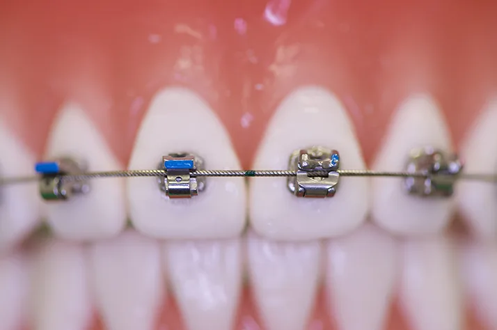Teeth with braces on the top set. They have speed braces and regular brace. The speed braces are smaller.