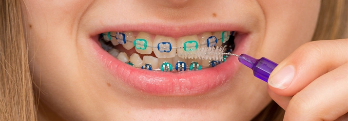 What to Eat (And What to Avoid) with Braces In The Woodlands TX